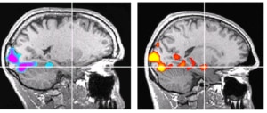 Il cervello di Honnold (sinistra) comparato con quello di un altro climber della medesima età (destra). @ Jane Joseph