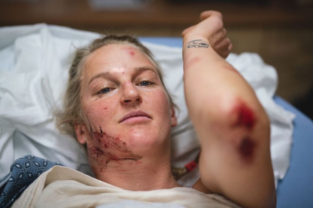Emily Harrington mostra le sue ferite dopo la caduta - Foto Instagram Tara Kerzhner