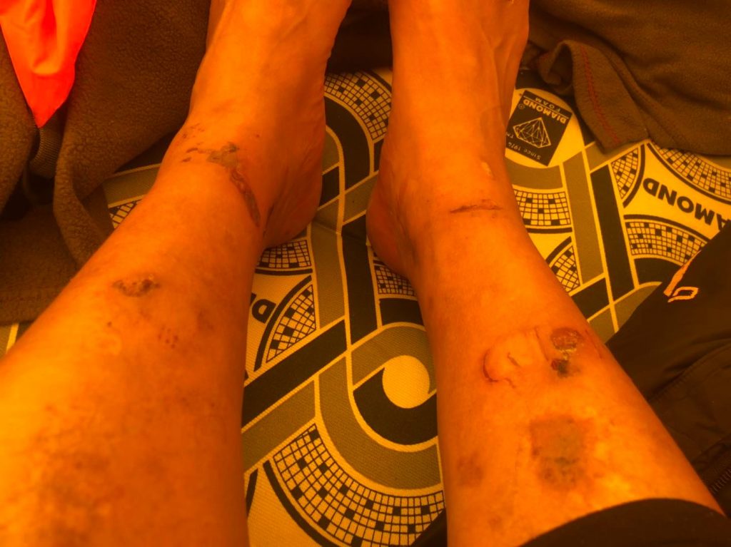 Conseguenze dei congelamenti. Foto @ Mingma G. 