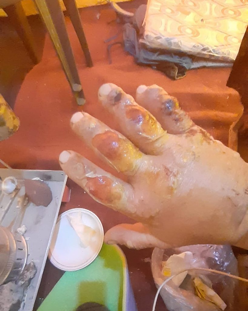 La mano di Denis Urubko. Foto Denis Urubko