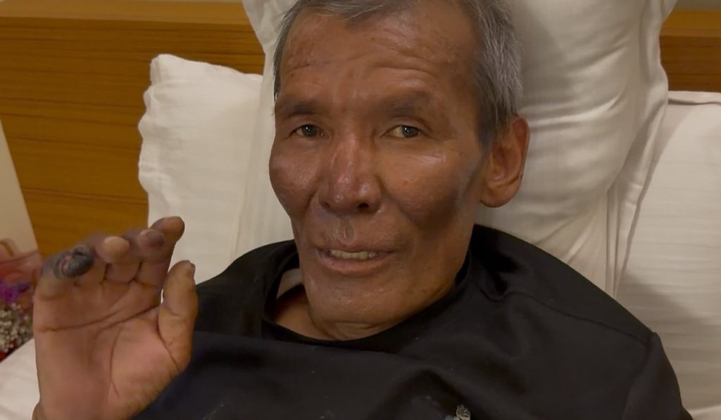 Dawa Sherpa in convalescenza a casa